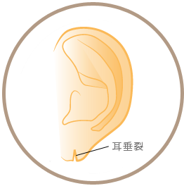 耳垂裂イメージ